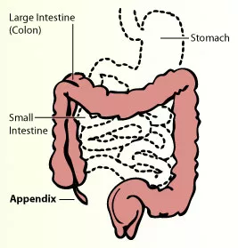 Appendicitis